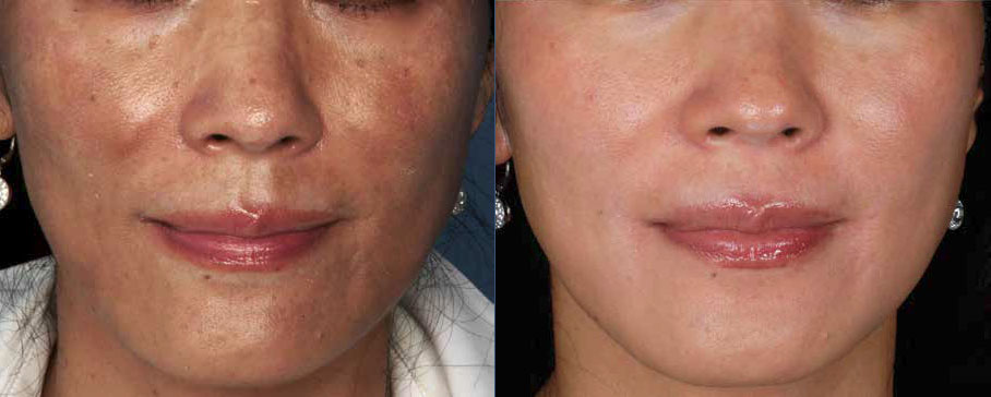 Hyperpigmentation Schaumburg Skypoint Medical