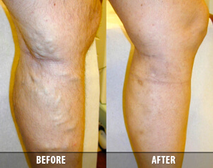Vein Therapy Skypoint Medical