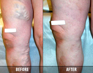 Vein Therapy Skypoint Medical