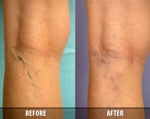 Vein Therapy Skypoint Medical