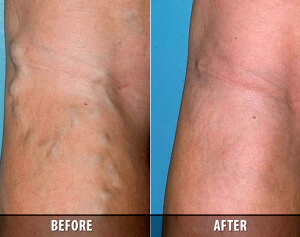Vein Therapy Skypoint Medical