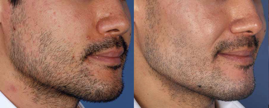Acne Schaumburg Skypoint Medical