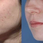 Acne Scarring Schaumburg
