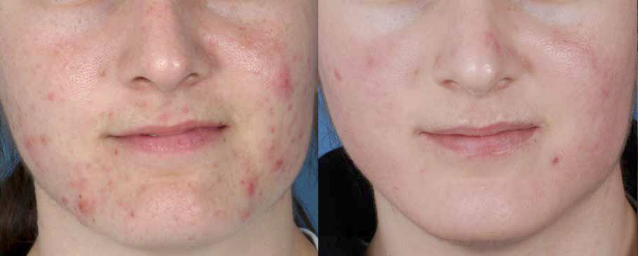 Acne Scarring Schaumburg Skypoint Medical