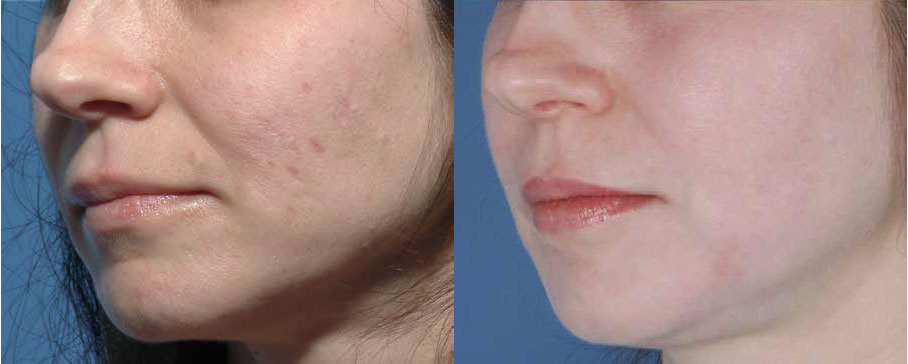 accutane for red scars