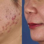 Photodynamic Therapy Schaumburg