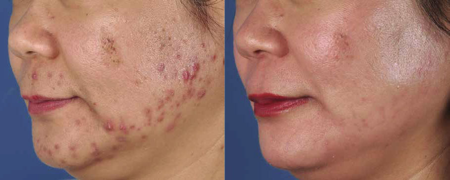 Photodynamic Therapy Schaumburg Blu U / PDT Skypoint Medical